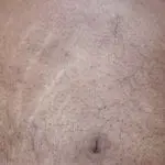 6 Cara Menghilangkan Stretch Mark di Tubuh Cara Menghilangkan Stretch Mark